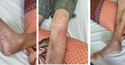 Tự ý dùng Corticoid trị gút khỏi đau nhanh tàn phế cả đời