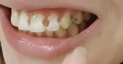 Cách phòng tránh sâu răng khi niềng răng