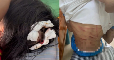 Công an vào cuộc vụ bé gái lớp 5 nghi bị cha dượng bạo hành
