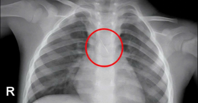 Kim chọc tủy rơi vào đường thở bé trai 3 tuổi khi làm răng