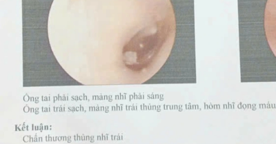 Vụ học sinh lớp 8 bị đánh hội đồng: Nạn nhân bị thủng màng nhĩ trái