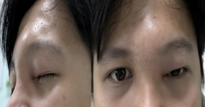 Nam thanh niên ở TPHCM suýt mất mạng vì tự chữa chảy mũi, biến chứng hiếm gây hủy