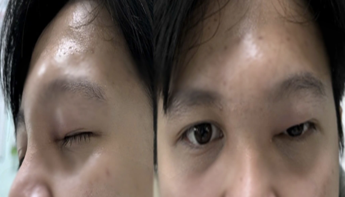 Nam thanh niên ở TPHCM suýt mất mạng vì tự chữa chảy mũi, biến chứng hiếm gây hủy