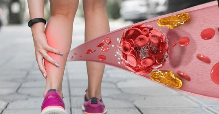 Tiến bộ trong chẩn đoán và điều trị bệnh mạch máu tại Việt Nam