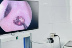 Đau nhức tai suốt một tuần, người phụ nữ tại Nghệ An tá hỏa phát hiện ve chó chết nằm sâu trong ống tai