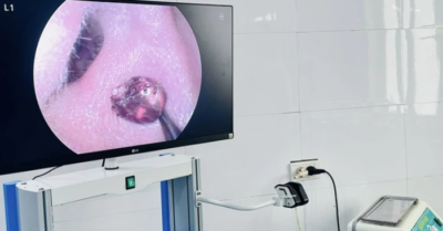 Đau nhức tai suốt một tuần, người phụ nữ tại Nghệ An tá hỏa phát hiện ve chó chết nằm sâu trong ống tai