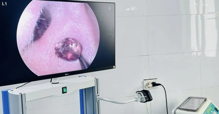 dị vật tai mũi họng