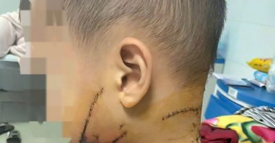 Bé trai nguy kịch sau khi bị chó nhà cắn, bác sĩ khuyến cáo không được chủ quan