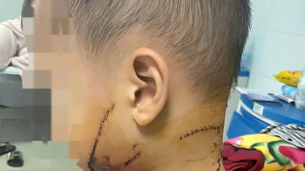 Bé trai bị chó nhà cắn nguy kịch, bác sĩ phát cảnh báo