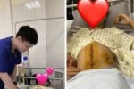 Ngã xe đạp điện, nữ sinh 15 tuổi phải cắt lách và thận để giữ mạng