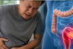 4 dấu hiệu sớm của ung thư trực tràng dễ bị nhầm với rối loạn tiêu hóa