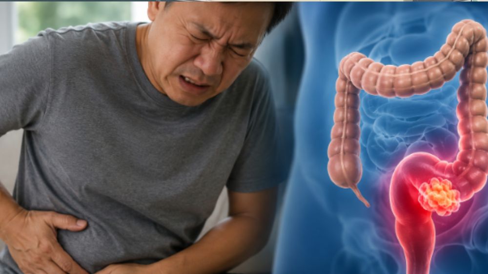 4 dấu hiệu sớm của ung thư trực tràng dễ bị bỏ qua