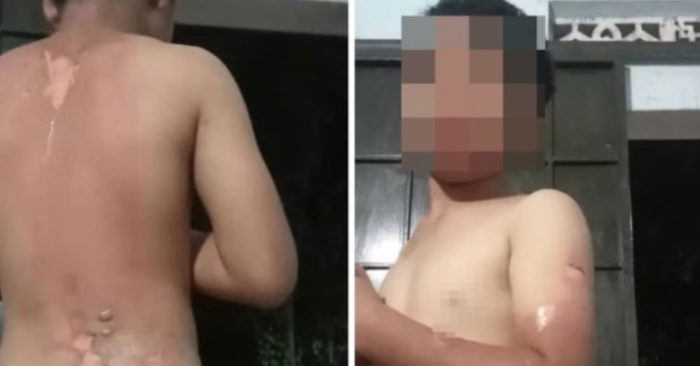 Bé trai ở Đắk Lắk nghi bị mẹ tạt nước sôi, công an xác minh