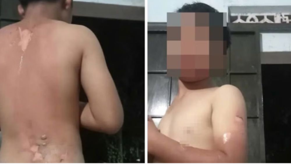 Bé trai ở Đắk Lắk nghi bị mẹ tạt nước sôi, công an xác minh