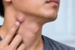 4 dấu hiệu cho thấy hạch ở cổ cần được kiểm tra