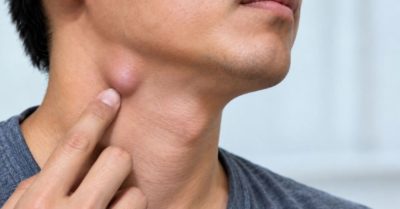 4 dấu hiệu cho thấy hạch ở cổ cần được kiểm tra