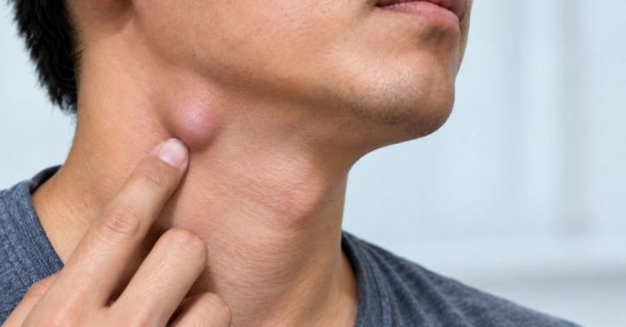 4 dấu hiệu cho thấy hạch ở cổ cần được kiểm tra