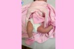 Bệnh viện Nhi Hải Phòng phẫu thuật thành công bé sơ sinh bị duỗi quá mức khớp gối