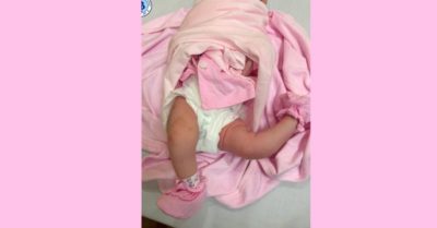 Bệnh viện Nhi Hải Phòng phẫu thuật thành công bé sơ sinh bị duỗi quá mức khớp gối