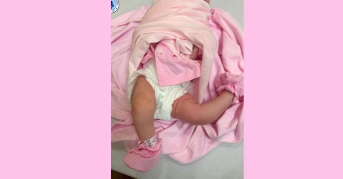 Bệnh viện Nhi Hải Phòng phẫu thuật thành công bé sơ sinh bị duỗi quá mức khớp gối