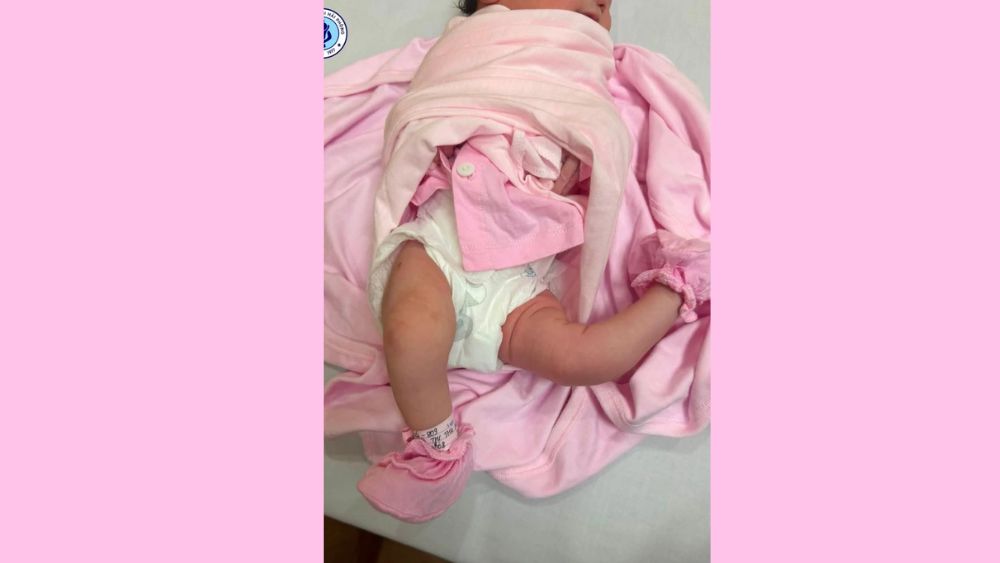 Bé sơ sinh bị duỗi quá mức khớp gối